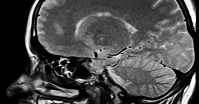 Atrophie corticale postérieure : le cas du syndrome de Benson